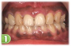 �K���s�[�����O�P