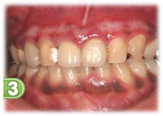 �K���s�[�����O�R