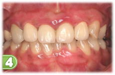 �K���s�[�����O�S