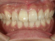 �E�H�[�L���O�u���[�`��